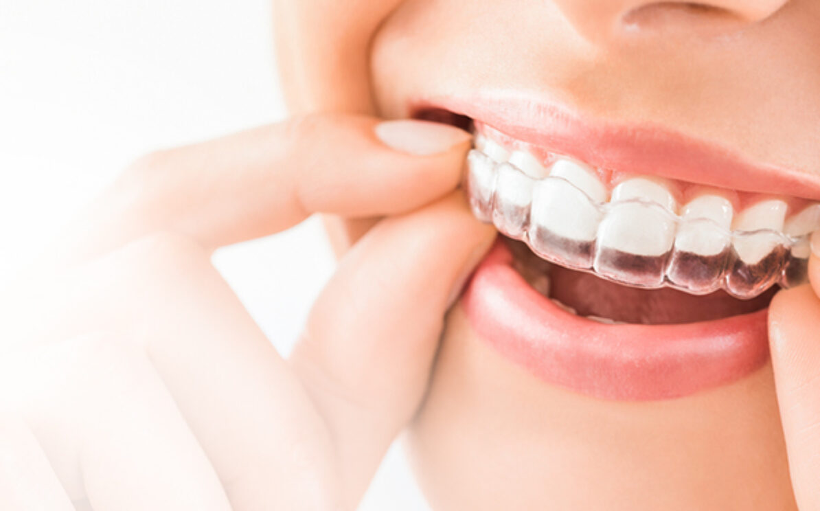 islingtonsmiles-blog-inner1