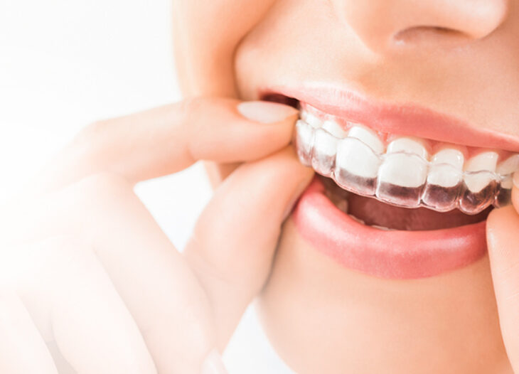 invisalign london