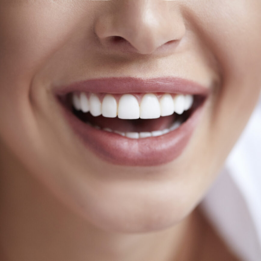 Cosmetic veneers
