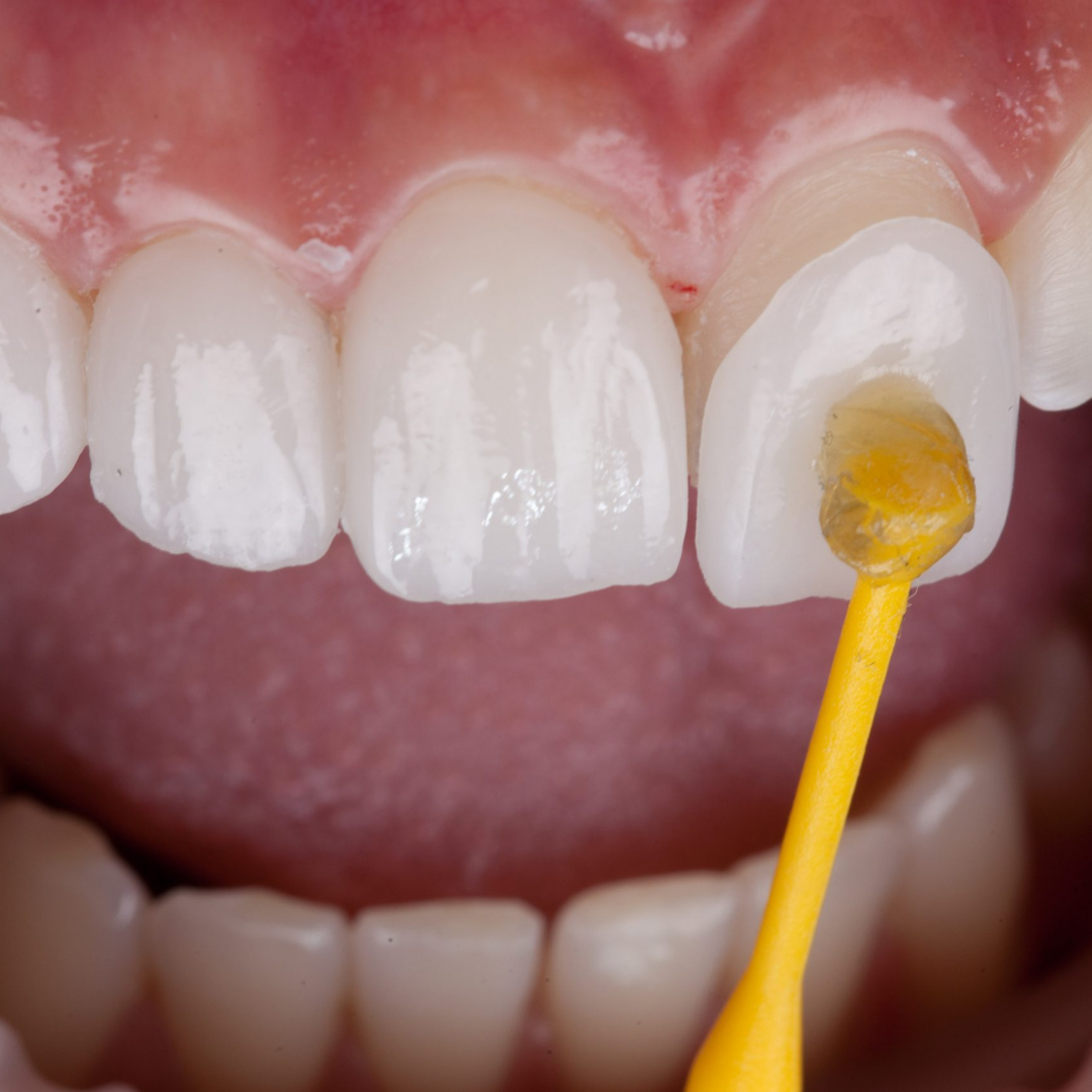 Thin dental veneers