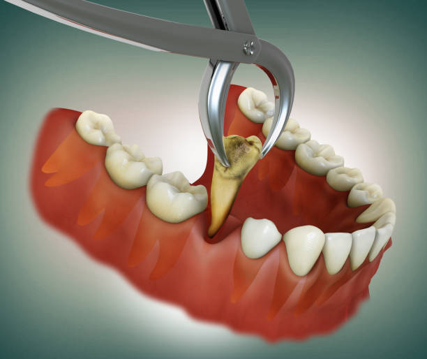 Dental Implant