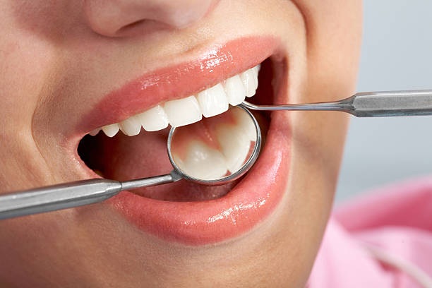 white fillings