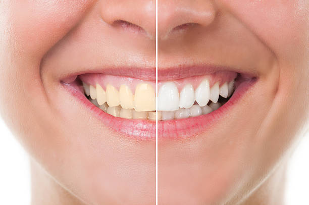 whitening treatment