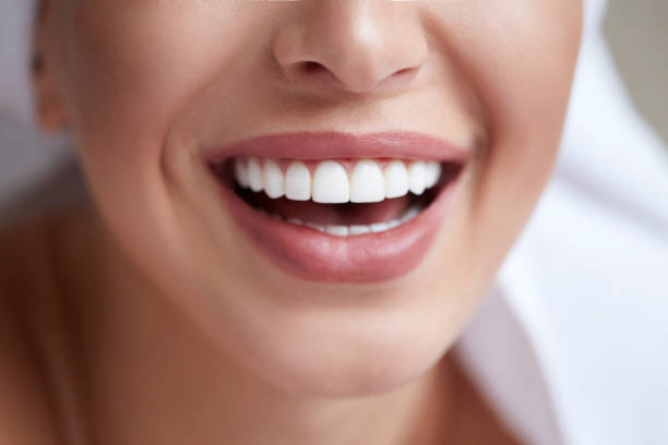 dental teeth whitening Islington