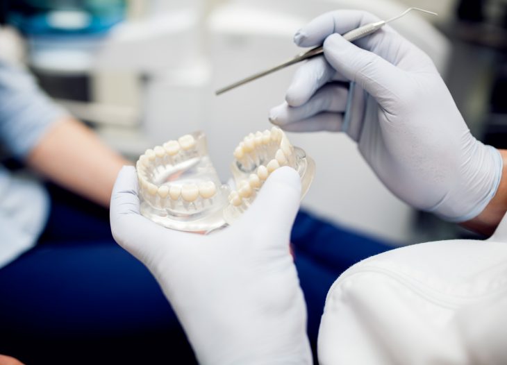 dental bridges