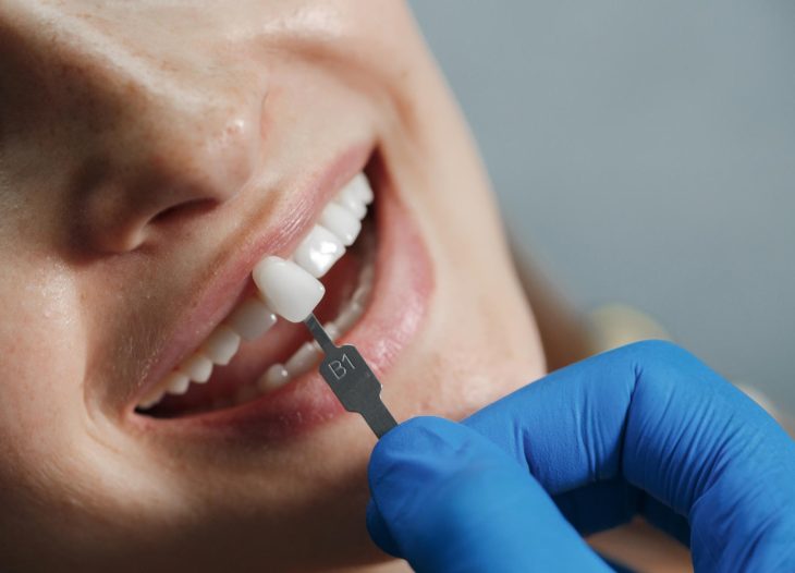 dental implants